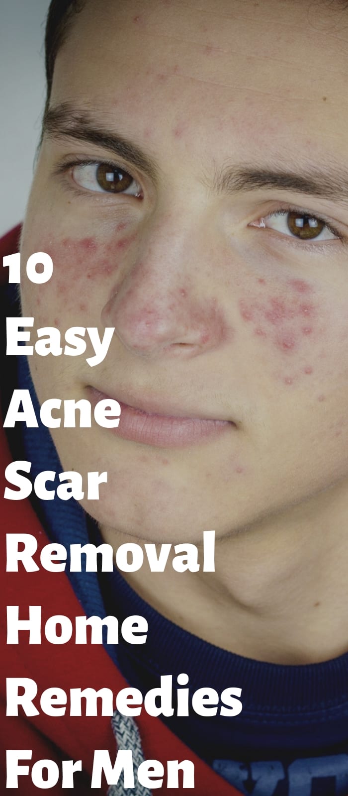 10 Easy Acne Scar Removal Home Remedies For Men! 10 Easy Acne Scar Removal Home Remedies For Men!