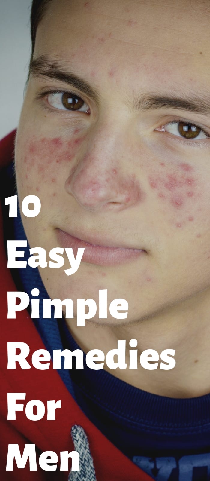 10 Easy Pimple Remedies For Men. 10 Easy Pimple Remedies For Men.