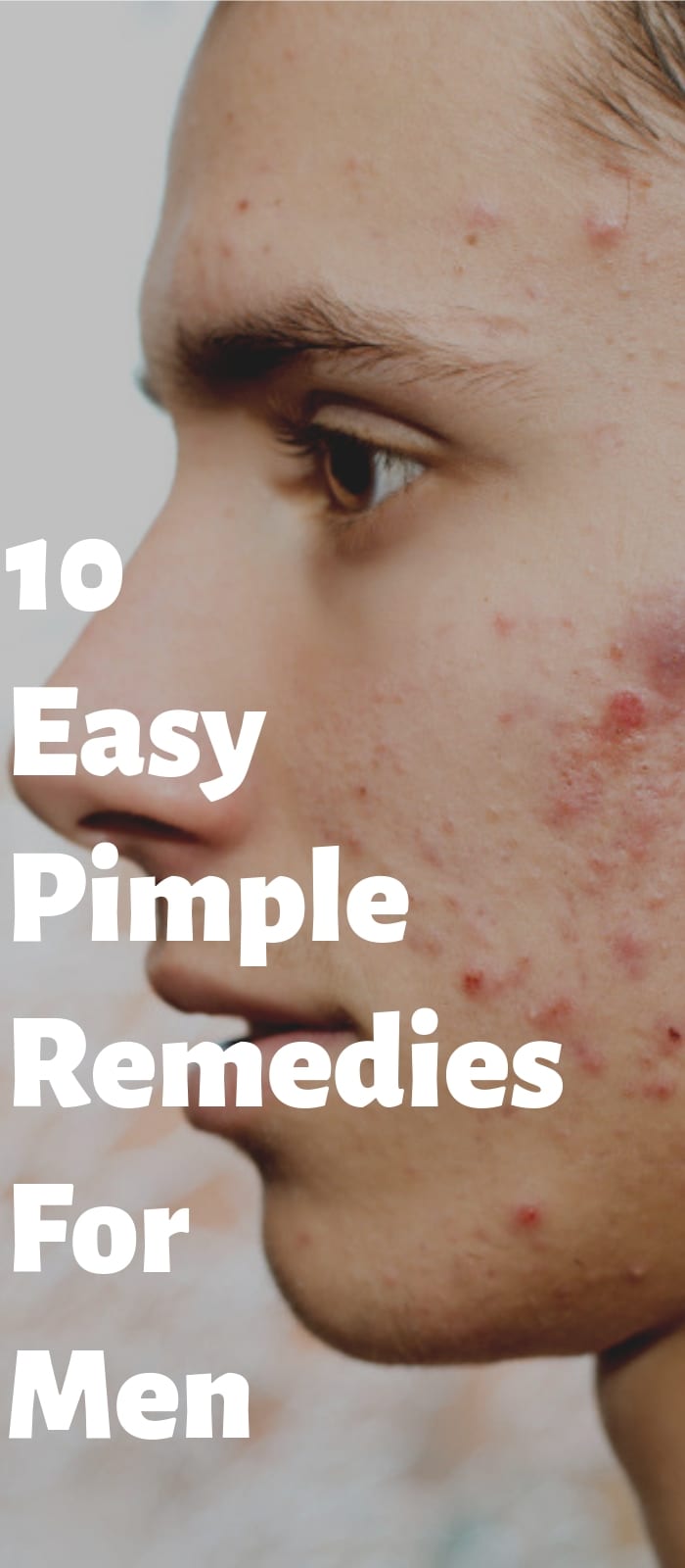 10 Simple Pimple Remedies For Men. 10 Simple Pimple Remedies For Men.